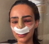 Bruna Biancardi fez a rinoplastia em 2018: à época postou vídeo da recuperação nas redes sociais