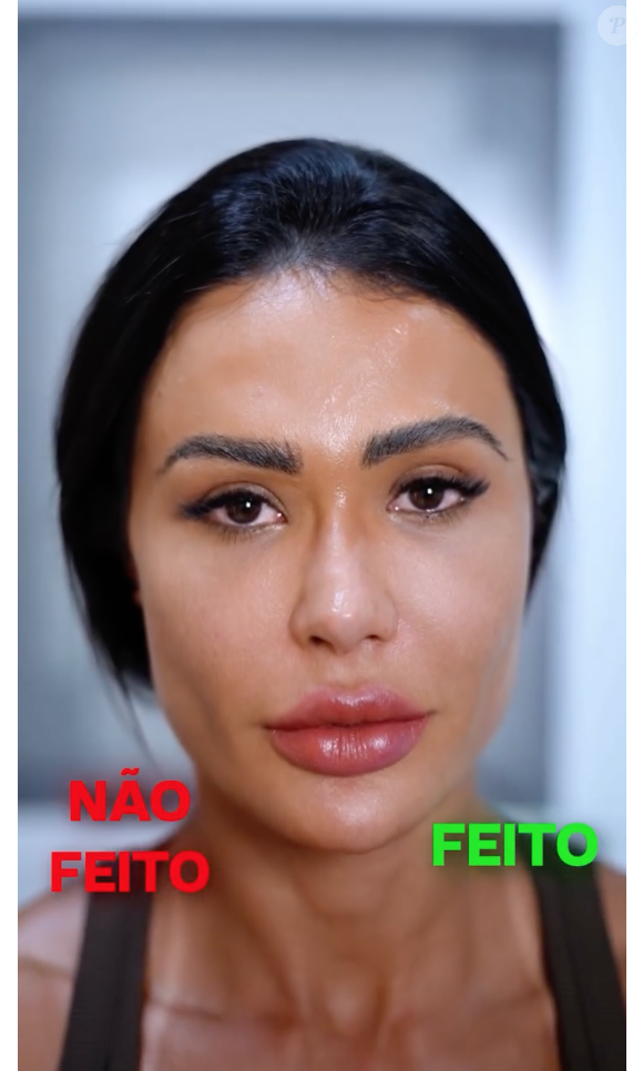 Este é o resultado da pele de Gracyanne Barbosa antes e depois da aplicação do laser XERF