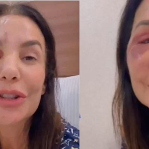 O que é o nervo vago? Neurologista explica relação com a síndrome vasovagal, diagnóstico de Ivete Sangalo que pode causar desmaios: ‘Corpo reage de forma exagerada’