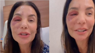 O que é o nervo vago? Neurologista explica relação com a síndrome vasovagal, diagnóstico de Ivete Sangalo que pode causar desmaios: ‘Corpo reage de forma exagerada’