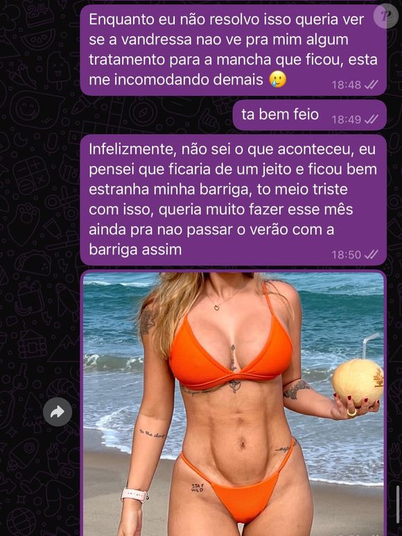 Mariana Tavares reclamava de manchas escuras na barriga após fazer lipo LAD