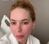 Nesta emana, Virgínia passou por um tratamento estético para amenizar as cicatrizes de acne da pele