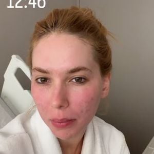 Nesta emana, Virgínia passou por um tratamento estético para amenizar as cicatrizes de acne da pele