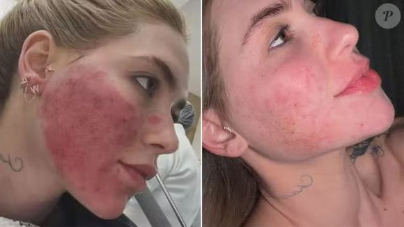 Durante o tratamento, Virginia Fonseca explicou que as manchas na pele surgiram após o processo para engravidar