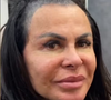 Gretchen fez o procedimento há cerca de três anos, com o objetivo de camuflar as falhas nos fios