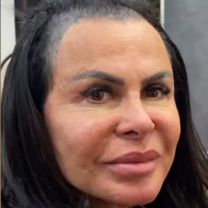 Gretchen fez o procedimento há cerca de três anos, com o objetivo de camuflar as falhas nos fios