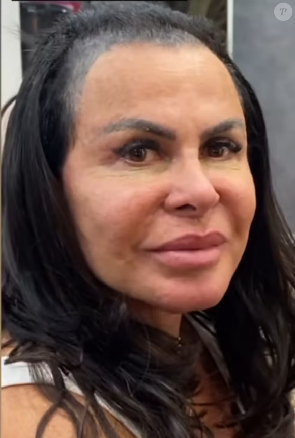 Gretchen fez o procedimento há cerca de três anos, com o objetivo de camuflar as falhas nos fios