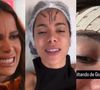 Microflebectomia: Anitta faz cirurgia e tira veia que salta da testa; entenda o procedimento e saiba se há riscos!