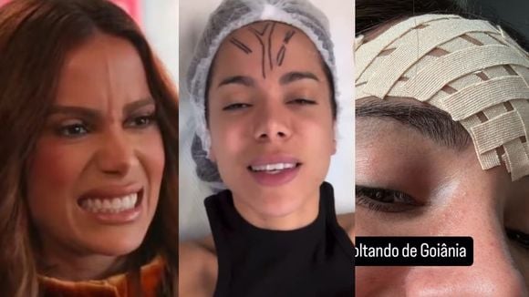 Microflebectomia: Anitta faz cirurgia e tira veia que salta da testa; entenda o procedimento e saiba se há riscos!