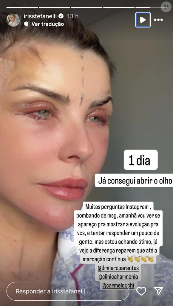 Íris Stefanelli chocou a web ao aparecer se recuperando de alguns procedimentos feitos há cerca de um mês