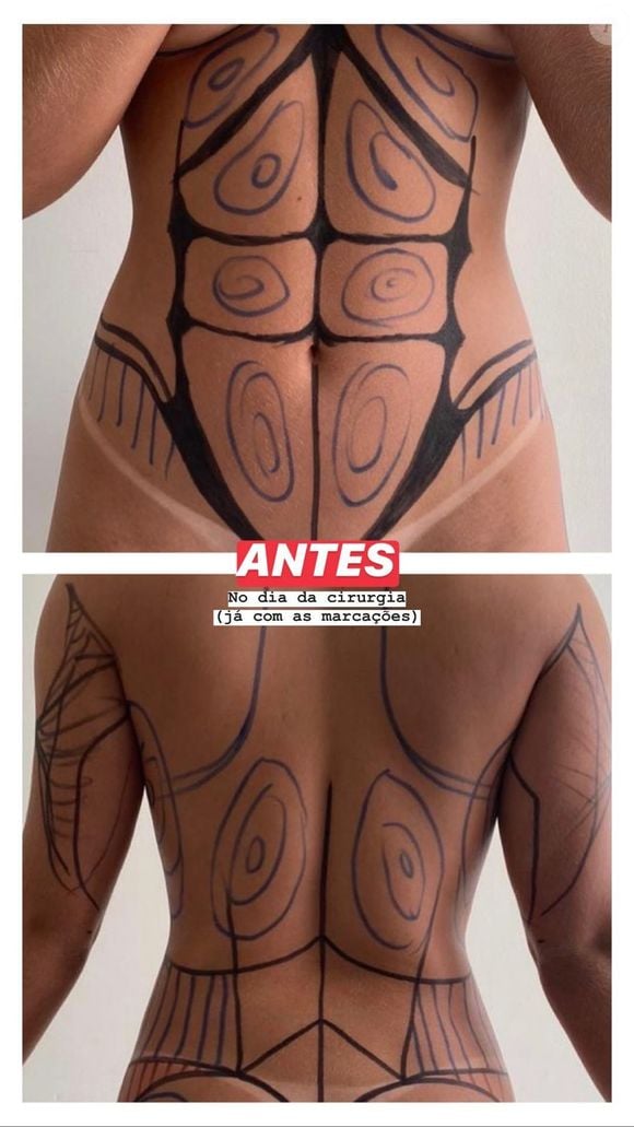 Gabriela Versiani mostra o corpo com marcações pré-lipo LAD na quarentena