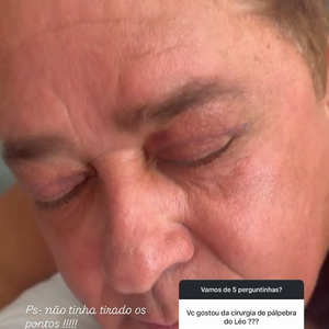 Leonardo fez uma cirurgia para remover a flacidez excessiva das pálpebras