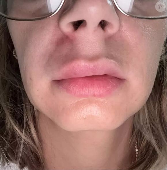 A norte-americana Alisha Monaco, de 32 anos, compartilhou uma experiência que serve de alerta para quem tem o hábito de cutucar a pele diante de uma espinha