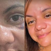 'Ainda tenho edemas': agredida com 61 socos em elevador, Juliana Soares mostra rosto 30 dias após cirurgia reparadora