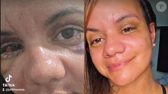 Agredida pelo namorado com 61 socos no elevador de seu prédio, Juliana Soares mostrou o resultado da cirurgia reparadora