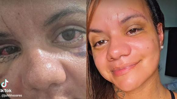 'Ainda tenho edemas': agredida com 61 socos em elevador, Juliana Soares mostra rosto 30 dias após cirurgia reparadora