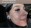 “Essas espinhas na minha cara… pra quem me acompanha há muito tempo, sabe que sofro com acne há muitos anos na minha vida. E agora comecei a tomar Roacutan, meu Deus do céu, gente. Até o Roacutan fazer efeito, essas bombinhas aqui vão sair tudo”, lembrou a cantora nas redes sociais.