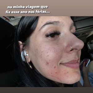 “Essas espinhas na minha cara… pra quem me acompanha há muito tempo, sabe que sofro com acne há muitos anos na minha vida. E agora comecei a tomar Roacutan, meu Deus do céu, gente. Até o Roacutan fazer efeito, essas bombinhas aqui vão sair tudo”, lembrou a cantora nas redes sociais.