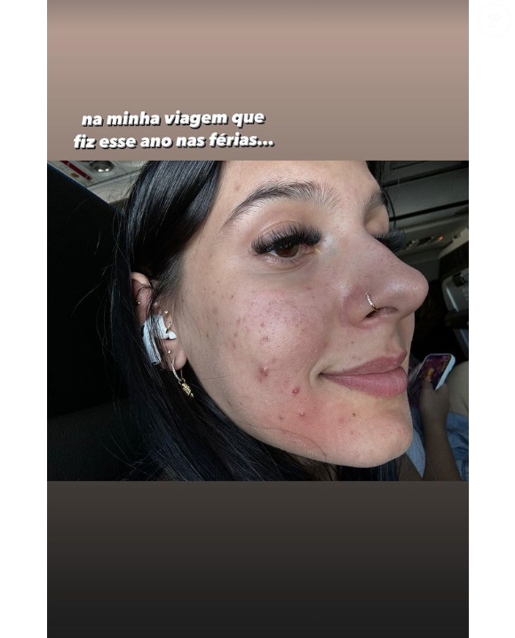 “Essas espinhas na minha cara… pra quem me acompanha há muito tempo, sabe que sofro com acne há muitos anos na minha vida. E agora comecei a tomar Roacutan, meu Deus do céu, gente. Até o Roacutan fazer efeito, essas bombinhas aqui vão sair tudo”, lembrou a cantora nas redes sociais.