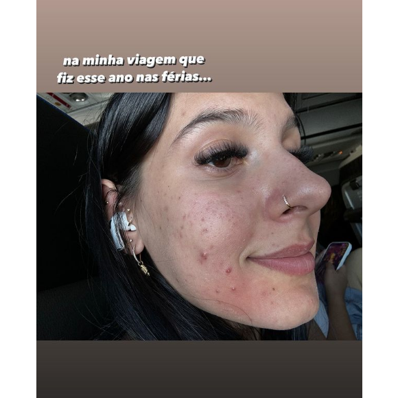 “Essas espinhas na minha cara… pra quem me acompanha há muito tempo, sabe que sofro com acne há muitos anos na minha vida. E agora comecei a tomar Roacutan, meu Deus do céu, gente. Até o Roacutan fazer efeito, essas bombinhas aqui vão sair tudo”, lembrou a cantora nas redes sociais.