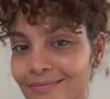 Lipedema de Bárbara Reis pode causar dor, inchaço e sensibilidade ao toque