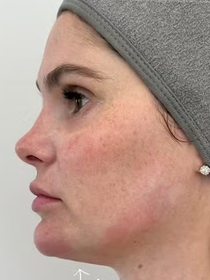Antes e depois Bárbara Evans: famosa recorre à nova técnica para diminuir papada menos de um ano após intervenção estética