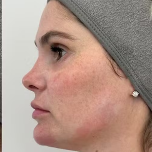 Antes e depois Bárbara Evans: famosa recorre à técnica para diminuir papada menos de um ano após intervenção estética