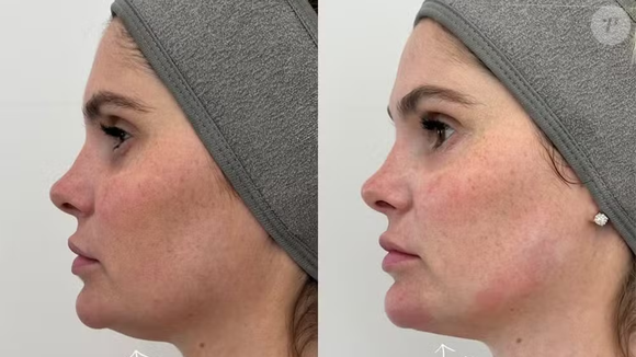 Antes e depois Bárbara Evans: famosa recorre à técnica para diminuir papada menos de um ano após intervenção estética