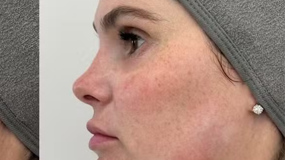Antes e depois Bárbara Evans: famosa recorre à nova técnica para diminuir papada menos de um ano após intervenção estética