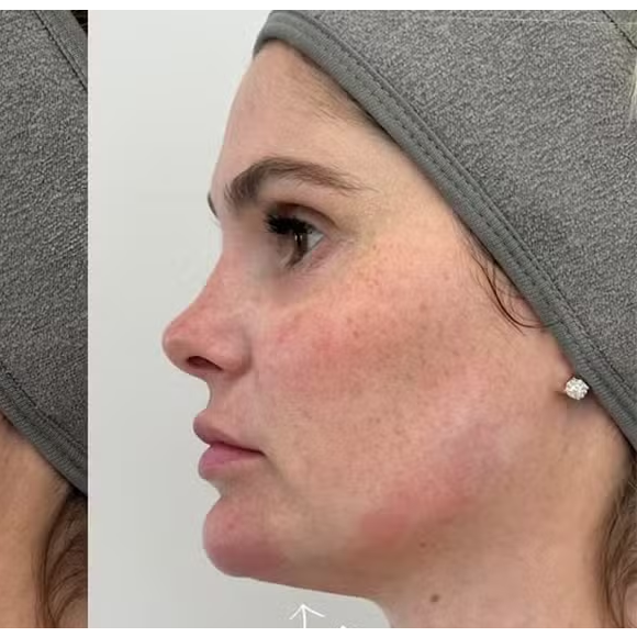 Antes e depois Bárbara Evans: famosa recorre à técnica para diminuir papada menos de um ano após intervenção estética