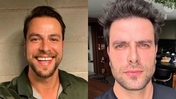 O ex-BBB Gustavo Marsengo também acabou com suas inseguranças com o transplante capilar, que deu um resultado espetacular