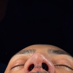 Além da estética, o influenciador queria corrigir o desvio de septo e hipertrofia dos cornetos nasais, conhecida como "carne esponjosa".