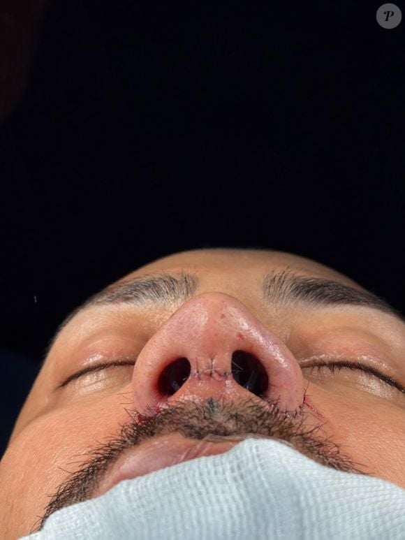 Além da estética, o influenciador queria corrigir o desvio de septo e hipertrofia dos cornetos nasais, conhecida como "carne esponjosa".