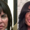 Antes e depois Gretchen: famosa exibe novo rosto após retirar preenchedores e estimular colágeno; cirurgiã plástica explica tratamentos