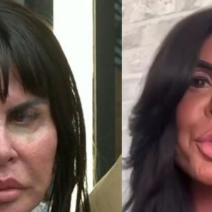 Antes e depois Gretchen: famosa exibe novo rosto após retirar preenchedores e estimular colágeno; cirurgiã plástica explica tratamentos