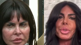 Antes e depois Gretchen: famosa exibe novo rosto após retirar preenchedores e estimular colágeno; cirurgiã plástica explica tratamentos
