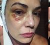Luiza Brunet exibiu o olho roxo após acusar Lirio Parissoto de agressão