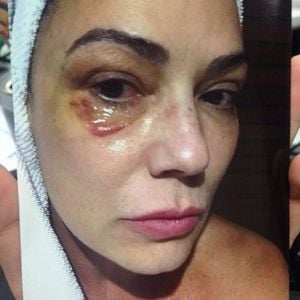 Luiza Brunet exibiu o olho roxo após acusar Lirio Parissoto de agressão