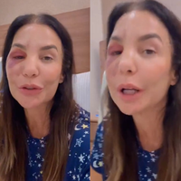 O que aconteceu com Ivete Sangalo? Cantora quebra dois ossos do rosto após desmaio, passa por cirurgia e surge inchada nas redes: ‘Estou bem’