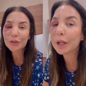 O que aconteceu com Ivete Sangalo? Cantora quebra dois ossos do rosto após desmaio, passa por cirurgia e surge inchada nas redes: ‘Estou bem’