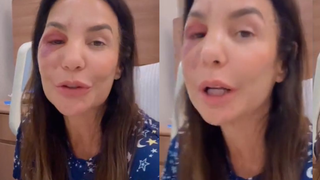 O que aconteceu com Ivete Sangalo? Cantora quebra dois ossos do rosto após desmaio, passa por cirurgia e surge inchada nas redes: ‘Estou bem’