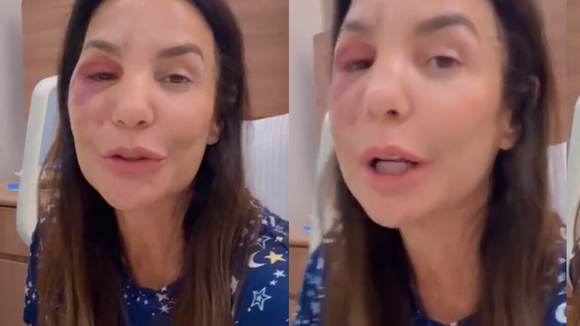 O que aconteceu com Ivete Sangalo? Cantora quebra dois ossos do rosto após desmaio, passa por cirurgia e surge inchada nas redes: ‘Estou bem’