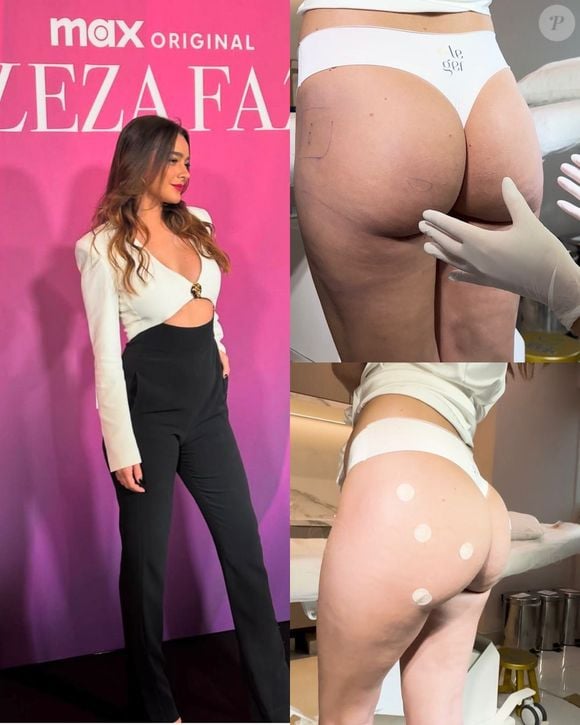 No elenco de 'Beleza Fatal', Mariana Molina realizou o procedimento para estimular a produção de colágeno no bumbum