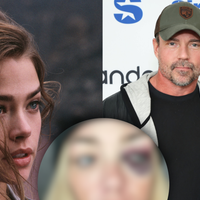 Estrela de '007', Denise Richards expõe fotos do rosto após ser espancada em episódio de paranóia do ex-marido: 'Me estrangulava'