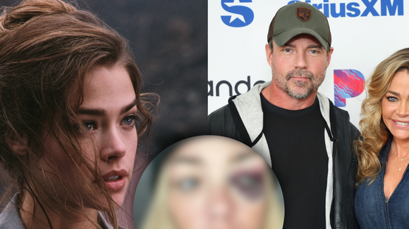 Estrela de '007', Denise Richards expõe fotos do rosto após ser espancada em episódio de paranóia do ex-marido: 'Me estrangulava'