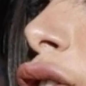 Anitta surgiu com lábios mais grossos após preenchimento labial