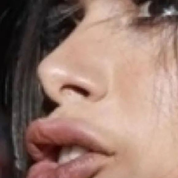 Anitta surgiu com lábios mais grossos após preenchimento labial