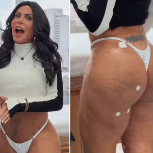 Gretchen também fez procedimento estético no bumbum