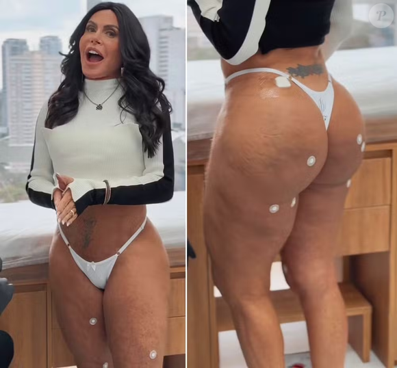 Gretchen também fez procedimento estético no bumbum