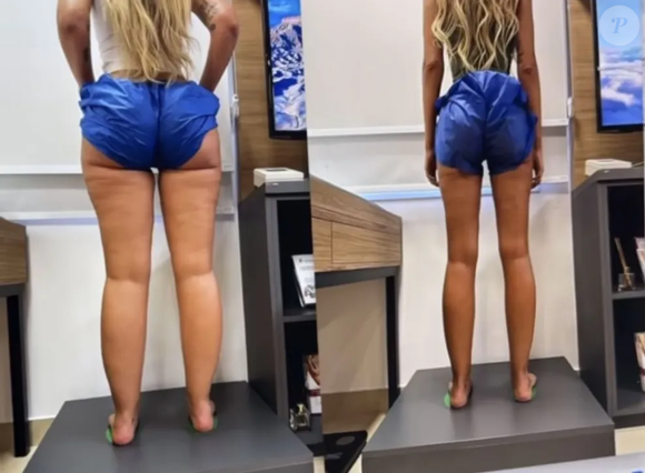 Yasmin Brunet mostrou o seu antes e depois do tratamento do lipedema nas pernas